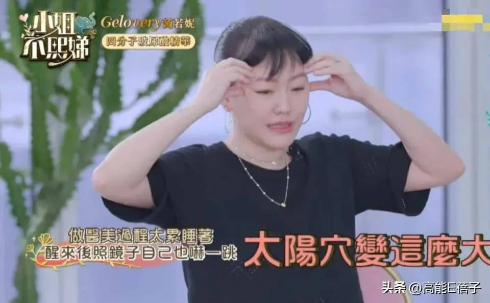 小S自曝打玻尿酸导致太阳穴肿胀