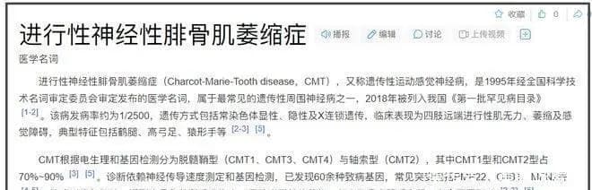 进行性神经性骨肌萎缩症相关医学资料示意图